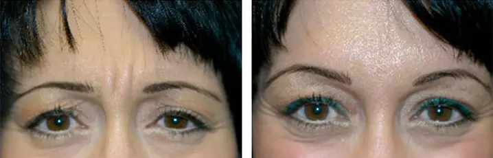 Botox In Scottsdale AZ